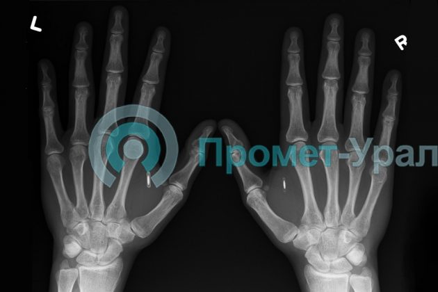 Когда делают рентген кистей рук?